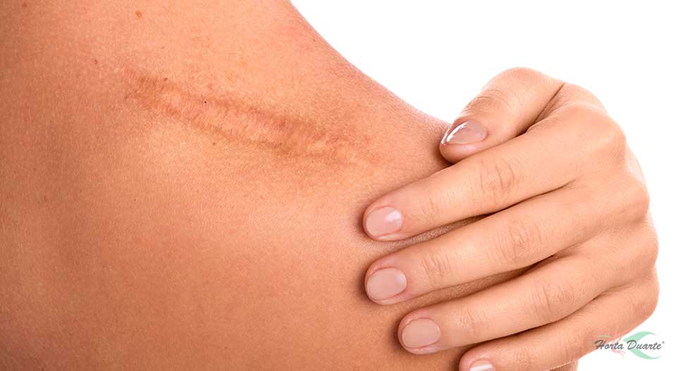 Infiltração de Cicatrizes: Como Funciona e Quais os Benefícios