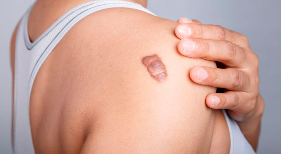 Queloides: O Que São e Como Tratar Essas Cicatrizes Elevadas
